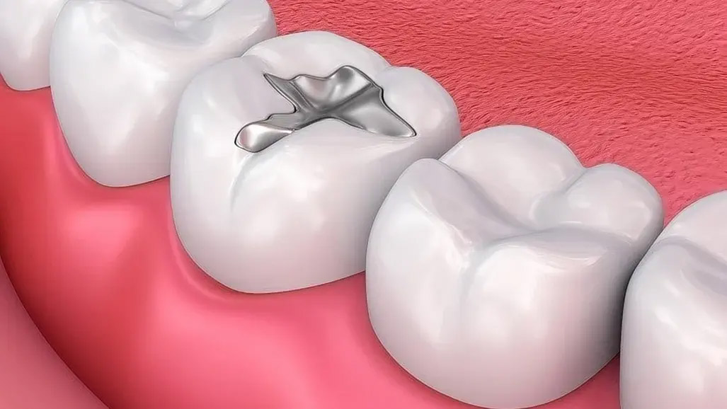 Preocupación por la eliminación prematura de la amalgama dental